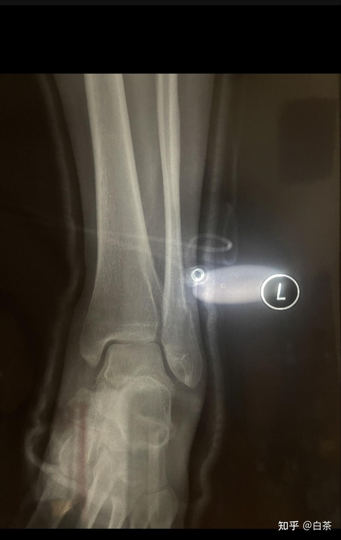脚踝(左腓骨远端)骨折月记 