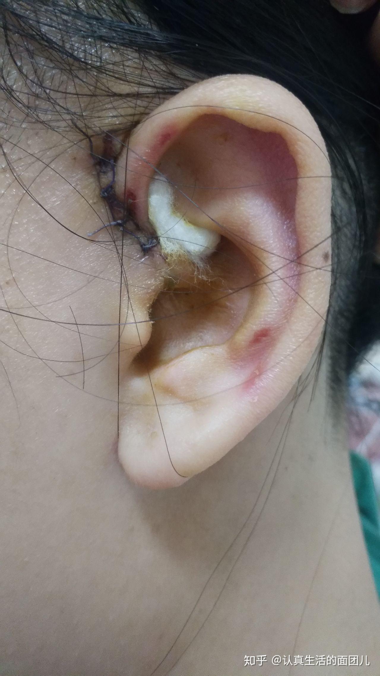 患有先天性耳前瘘管是一种怎样的体验