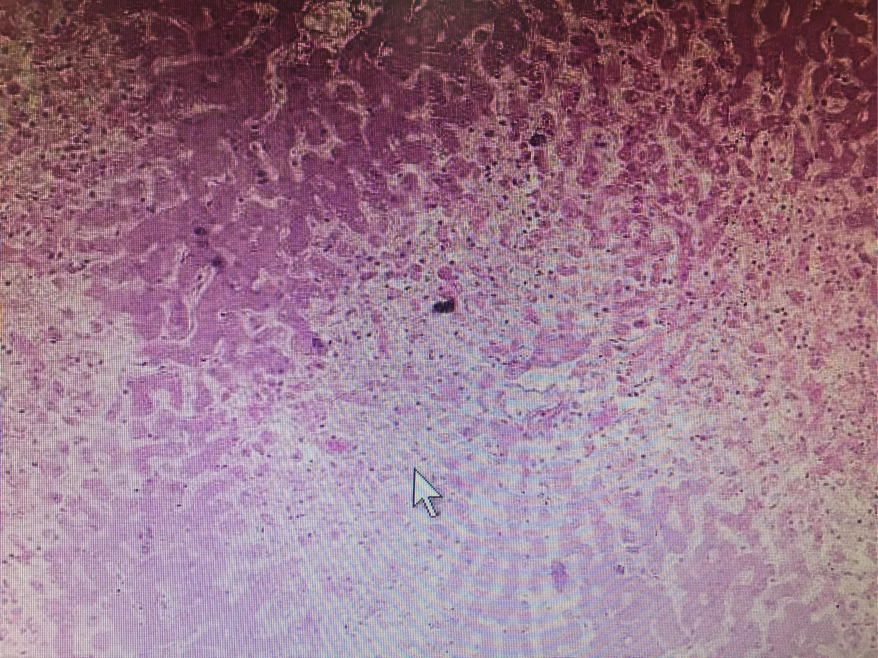 求脾贫血性梗死的镜下图或者手绘图