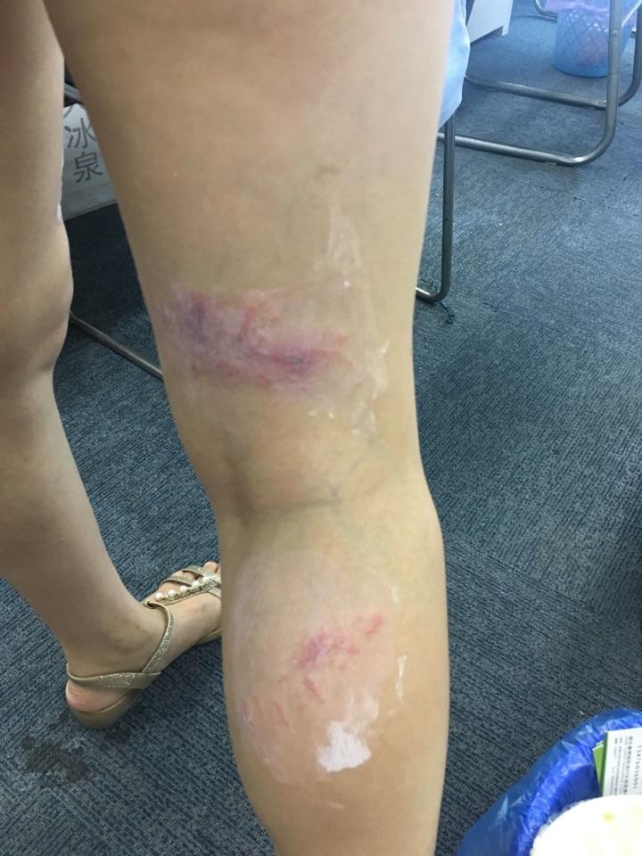 隐翅虫爬过后脸上留下很多深色的印迹很长时间了怎样去除