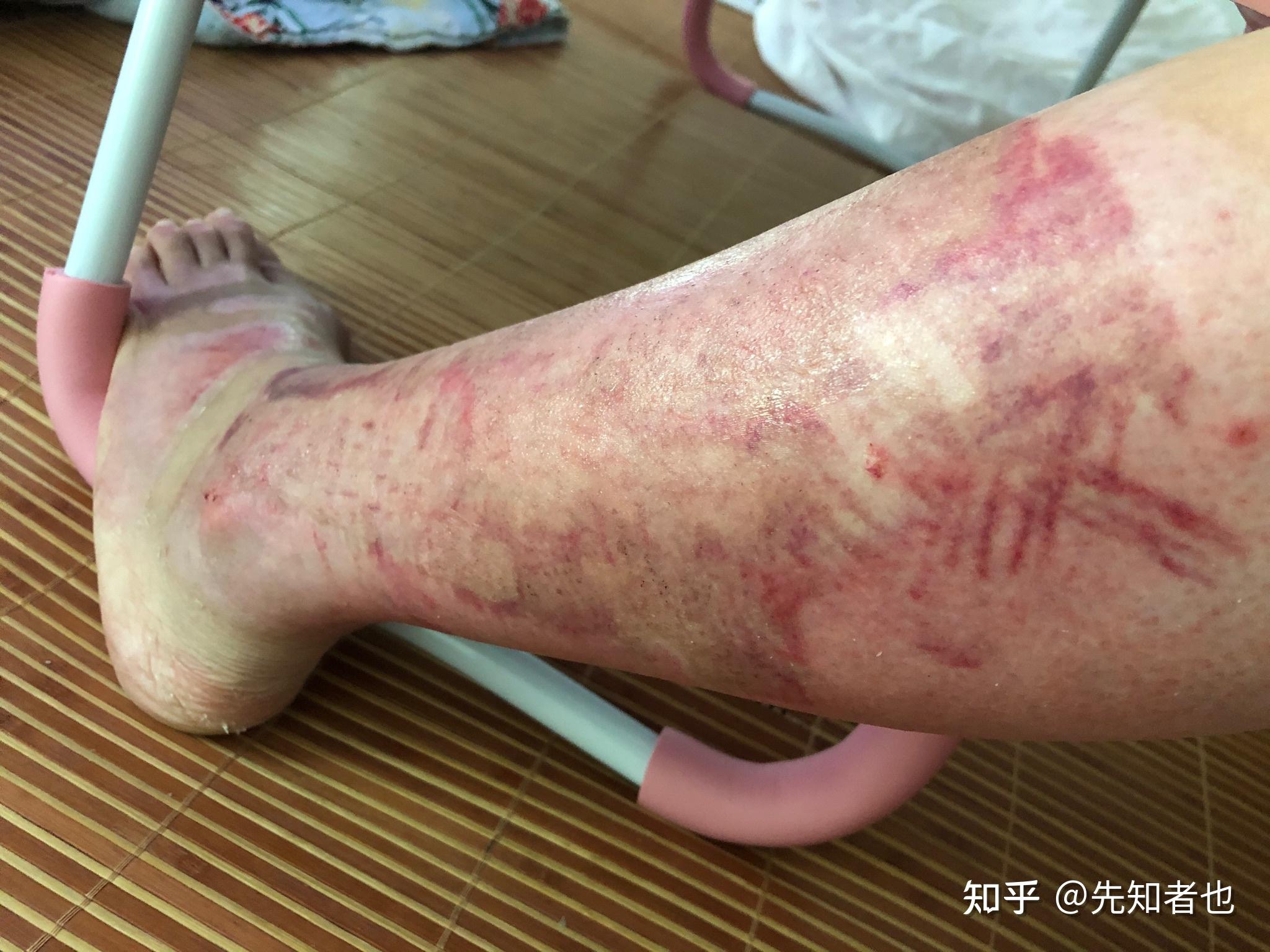 黑色素要淡一些了,5月26号大腿取皮区上面条纹状的,感觉有点疤了小腿