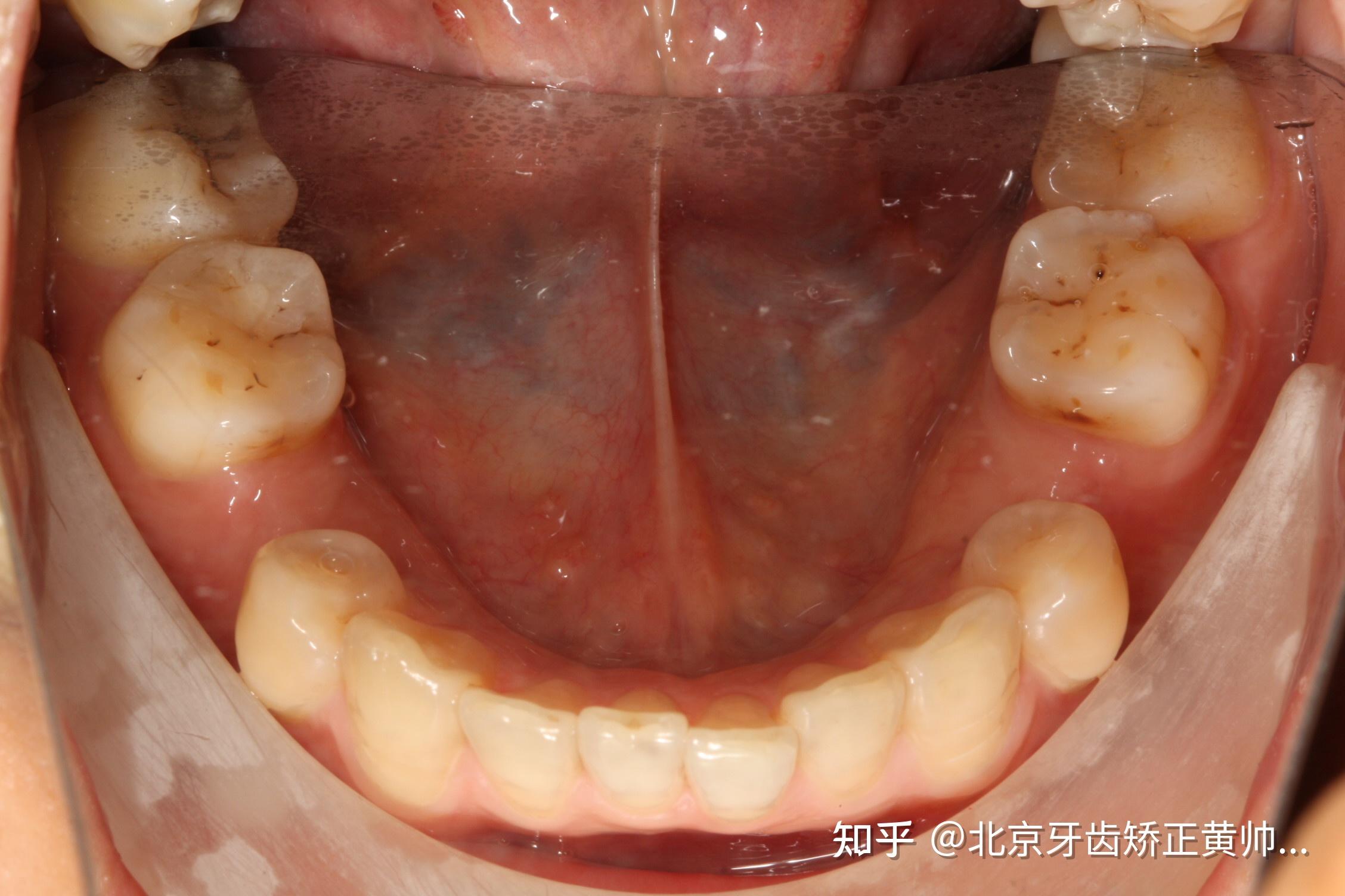 缺牙是种牙好还是正畸好