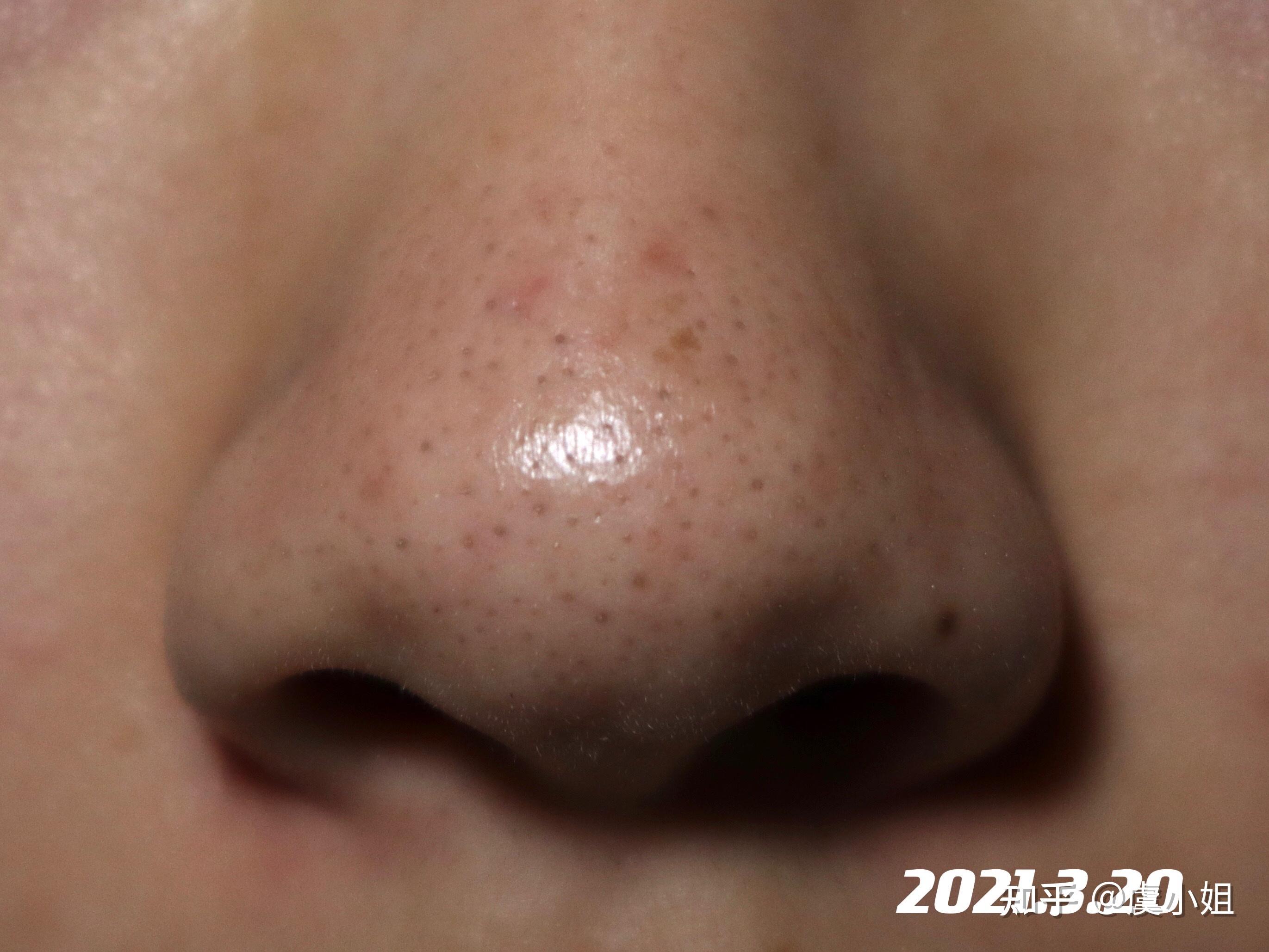 维a酸乳膏去黑头记录贴