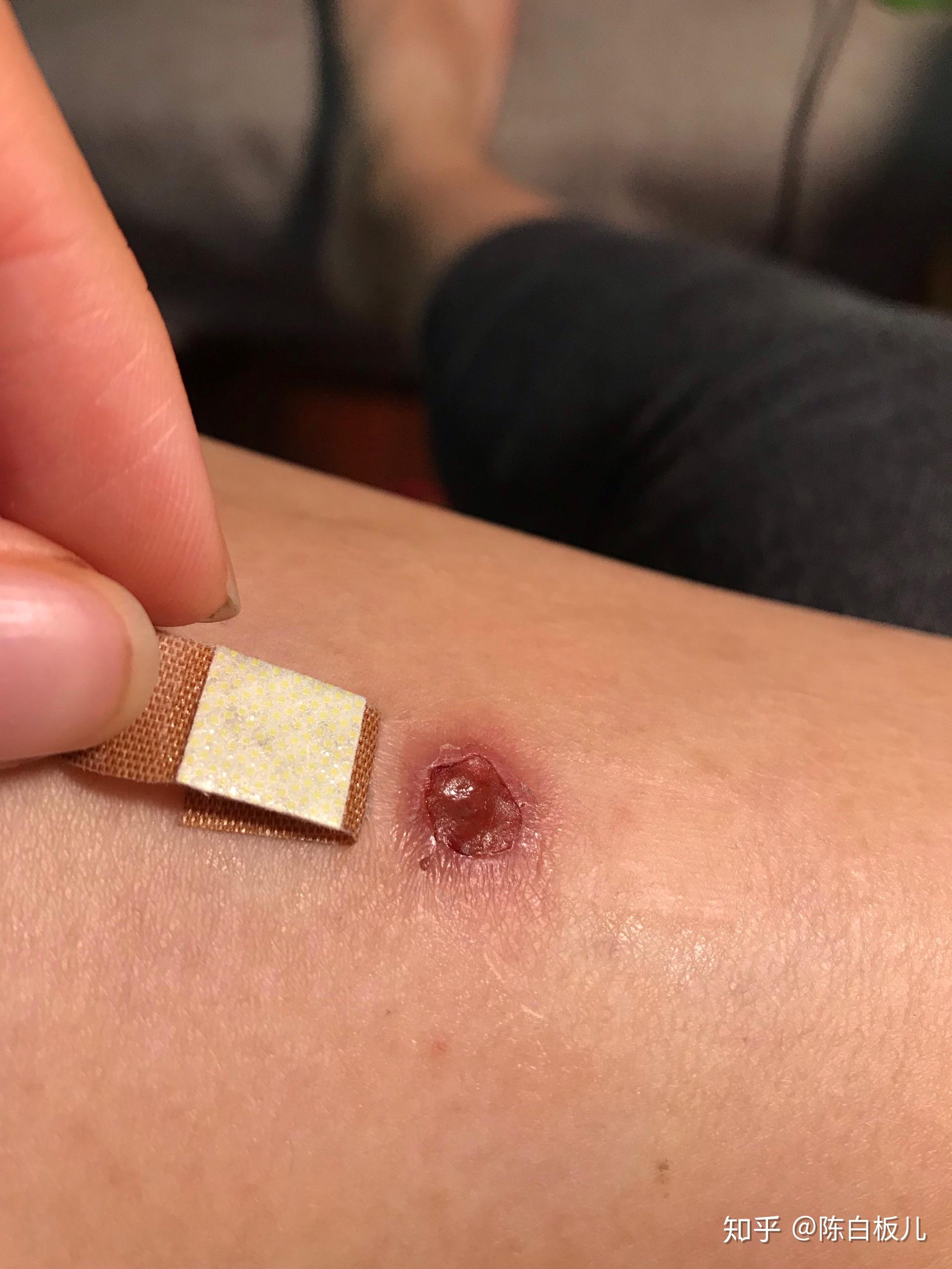 激光祛疣后如何避免留疤