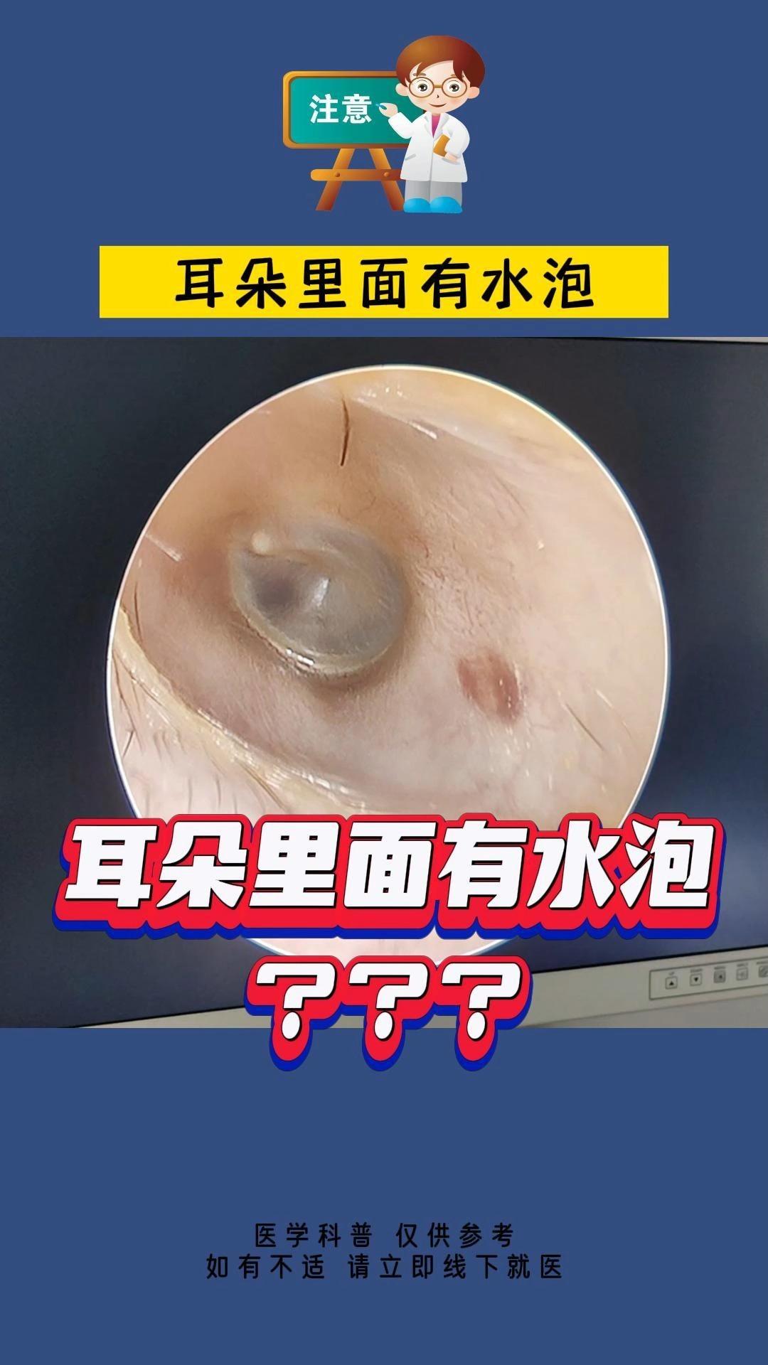 耳朵里面有水泡