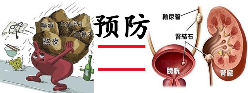 结石最爱年轻人,预防结石刻不容缓!