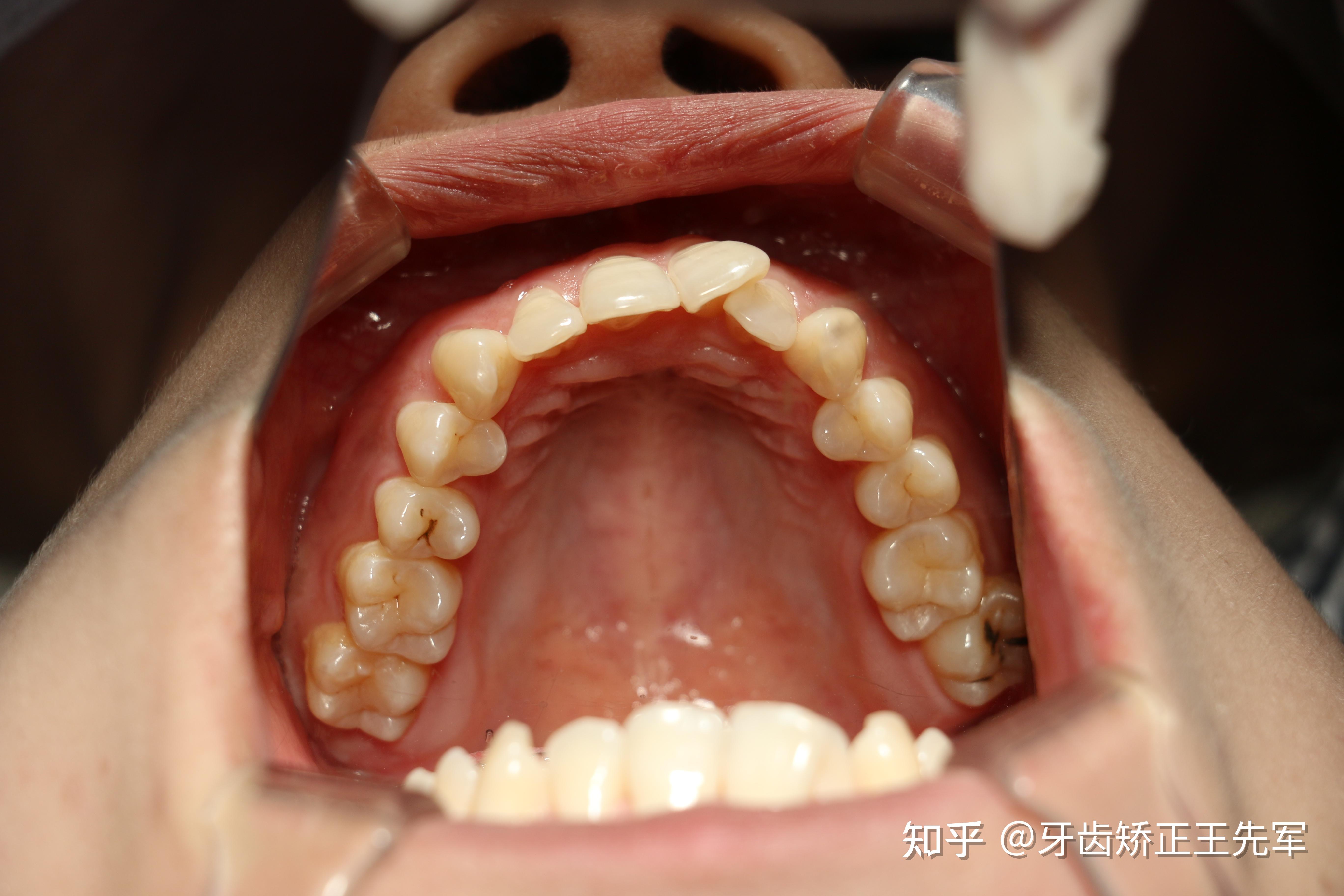 苏州牙齿矫正隐适美矫正案例分享分析