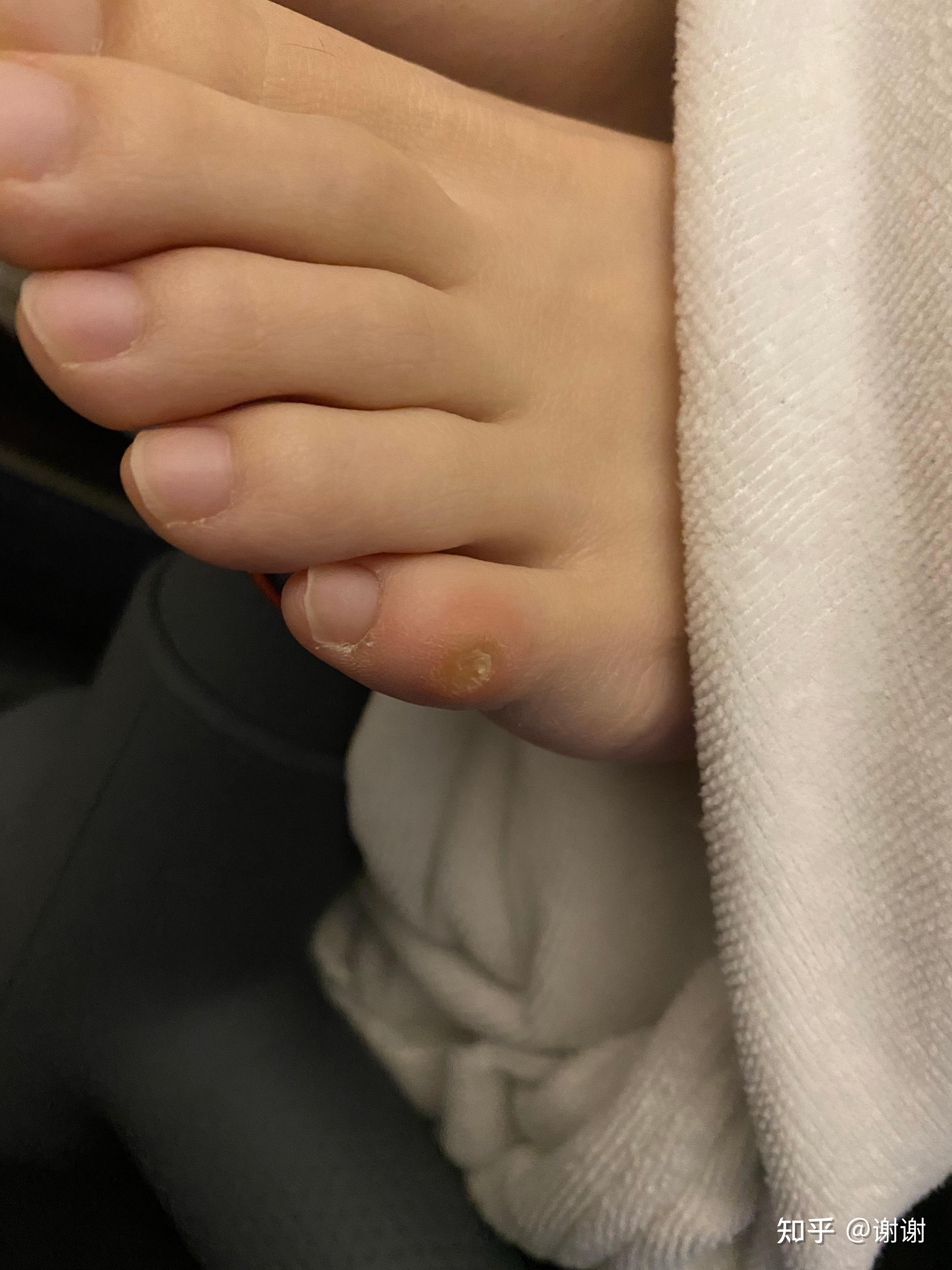 脚小拇指肿了,碰一下就很痛,请问什么原因