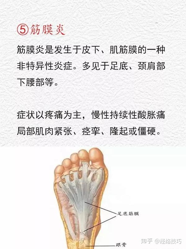 如何分辨滑膜炎、骨膜炎、滑囊炎、腱鞘炎、筋膜炎 知乎