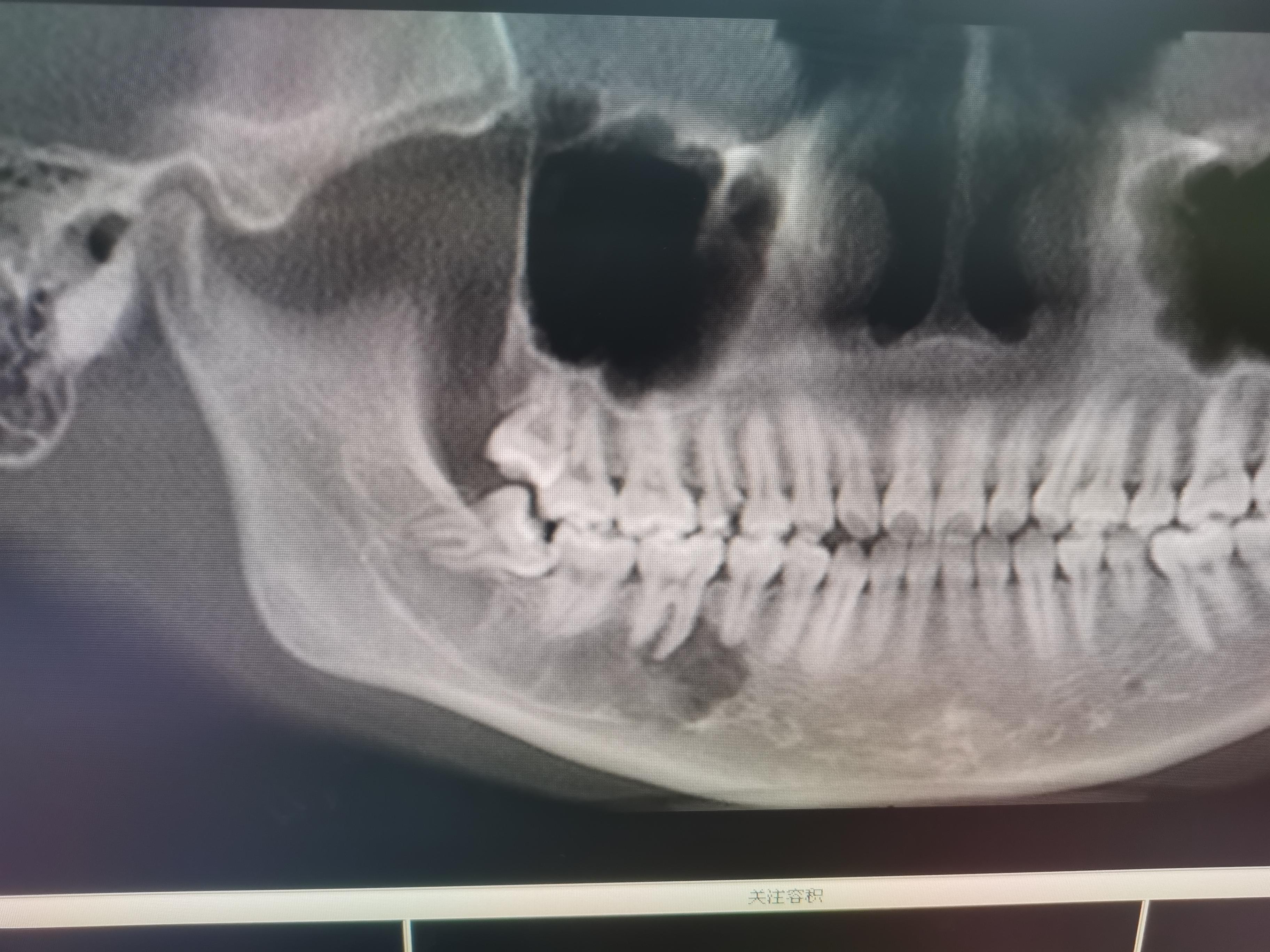 下颌骨的结构与形态特点_颅骨