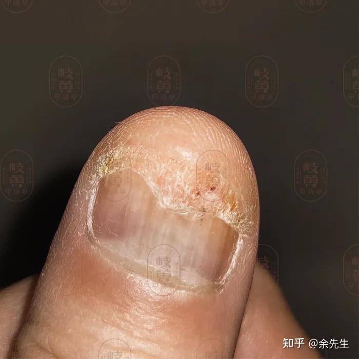左脚小拇指指甲变黄变厚好像两层的感觉好像是穿了一次挤脚的鞋之后