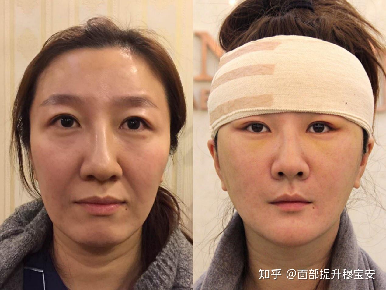 【案例一】美娜,37岁,杂志社主编拉皮手术案例讲解>>>>干货分享医学