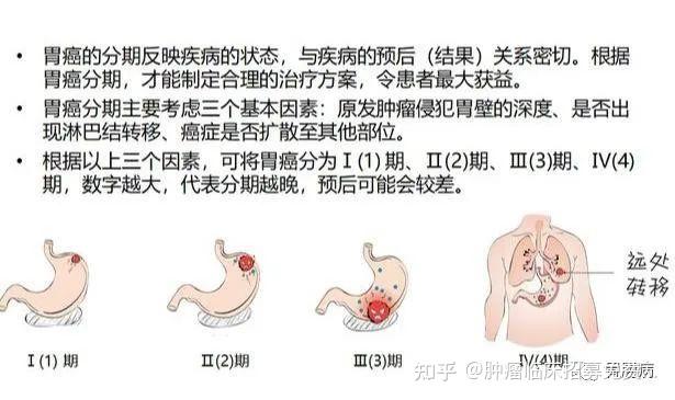 胃癌上身往往悄無聲息醫生教你如何早期發現