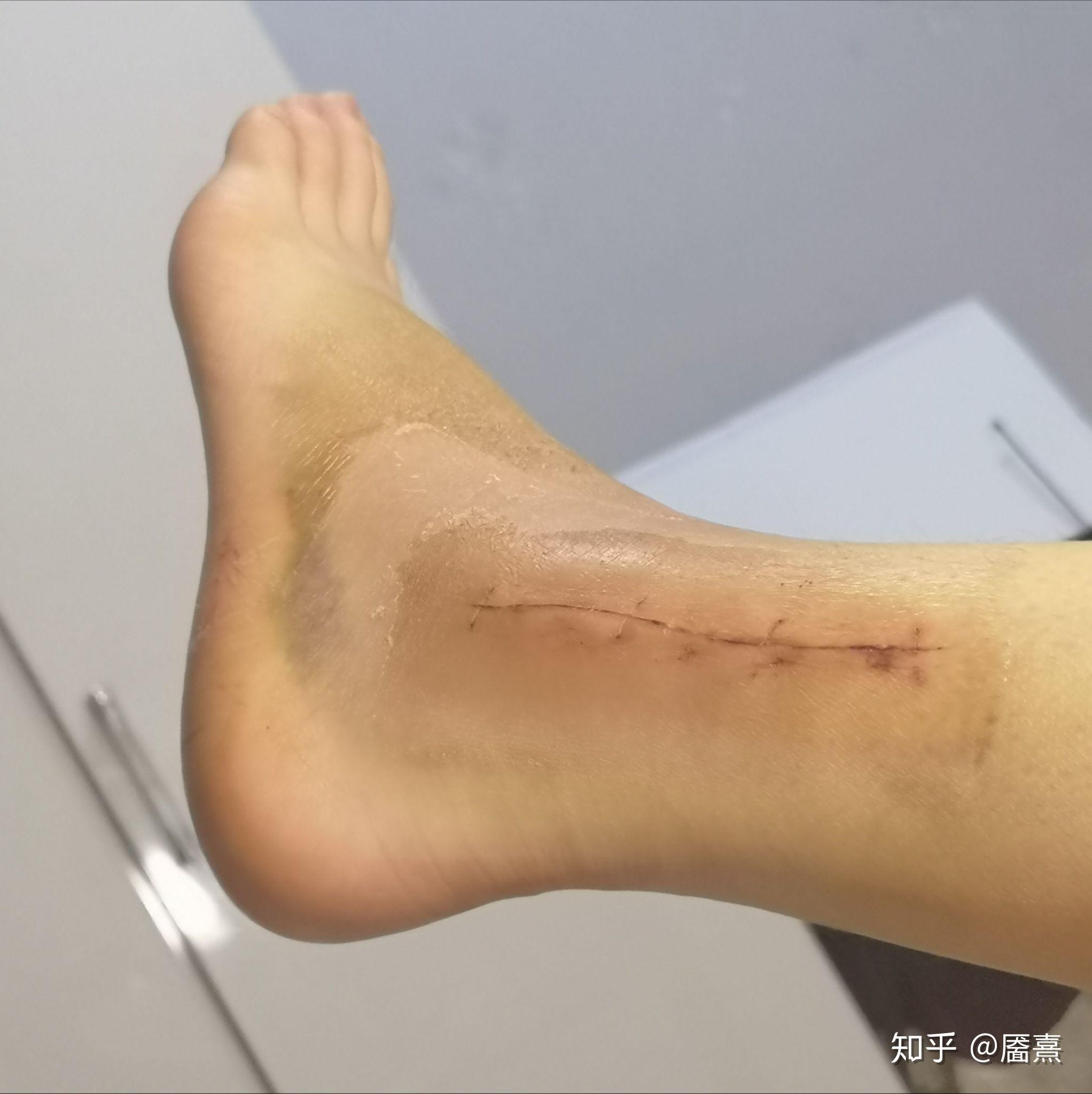 我的三踝骨折记录