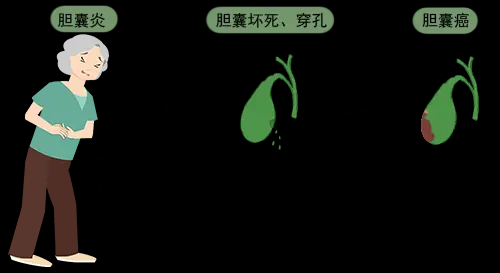 胆囊炎是怎么引起的? - 知乎