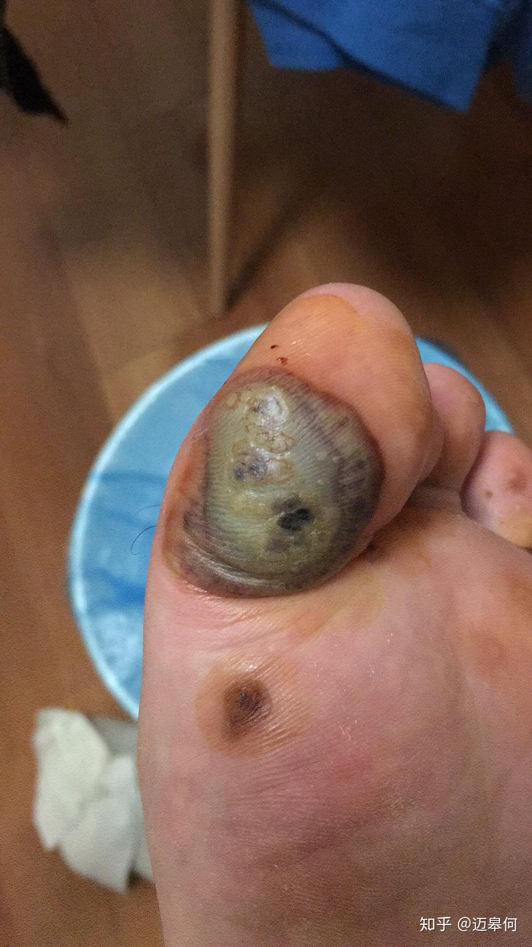 脚底长跖疣怎么办