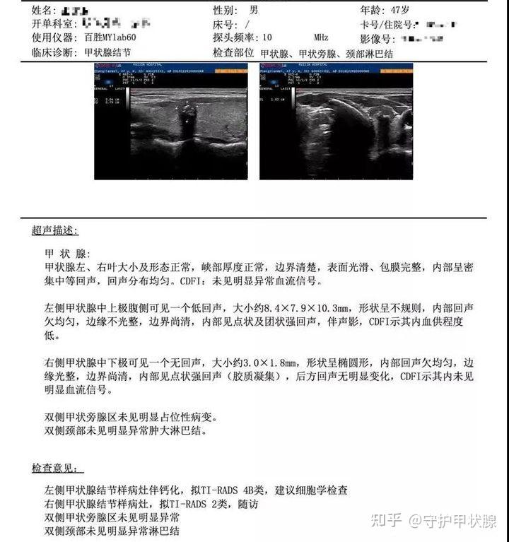 甲状腺超声报告不会看一文教你看懂甲状腺超声报告