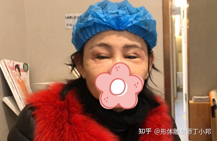 57岁退休女士来取奥美定取出后面部恢复自然