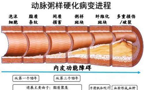 动脉粥样硬化可能大家比较陌生,简单说就是斑块;这些动脉粥样硬化如果