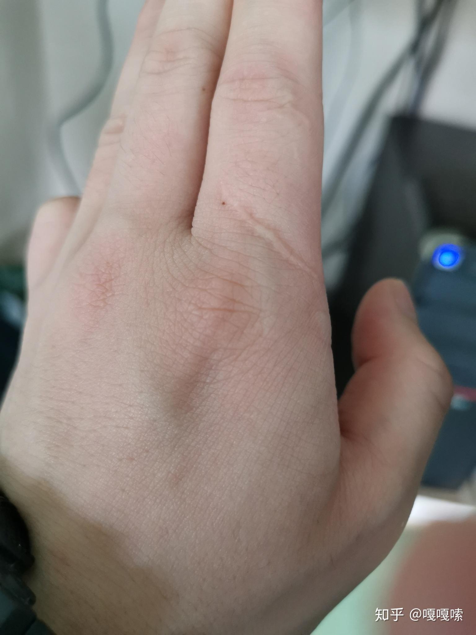 男左手腕外侧有痣 v2-c66cb512e9b370b286a5d32e951837a8_r.jpg