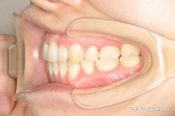 龅牙前突患者的正畸治疗