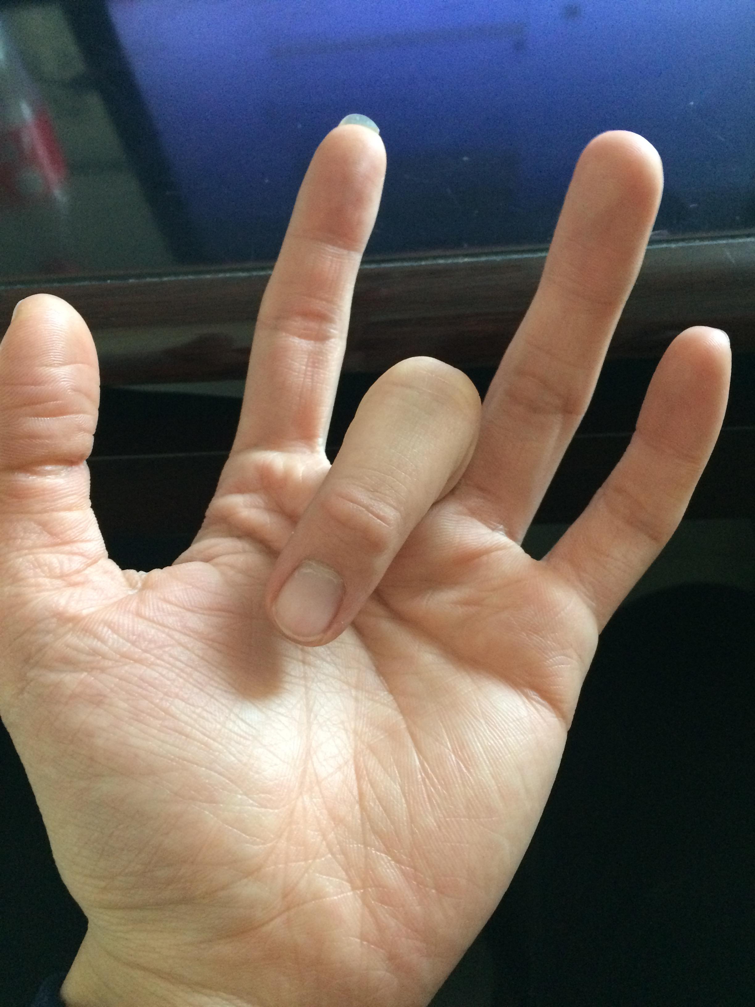 手指弯曲是什么原因造成的