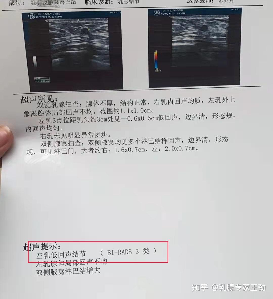 乳腺结节3类变4a类恶性的几率增加了