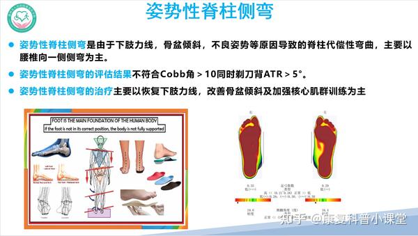 特发性脊柱侧弯的诊疗策略 - 知乎