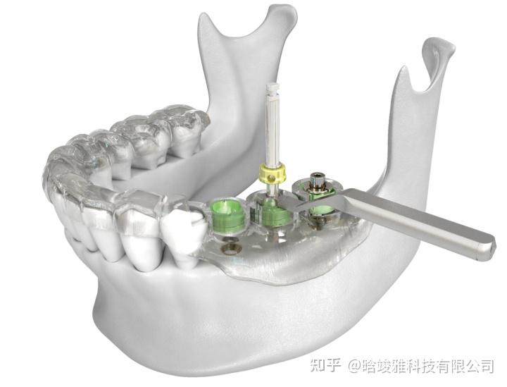 数字化种植导板精准性的影响因素