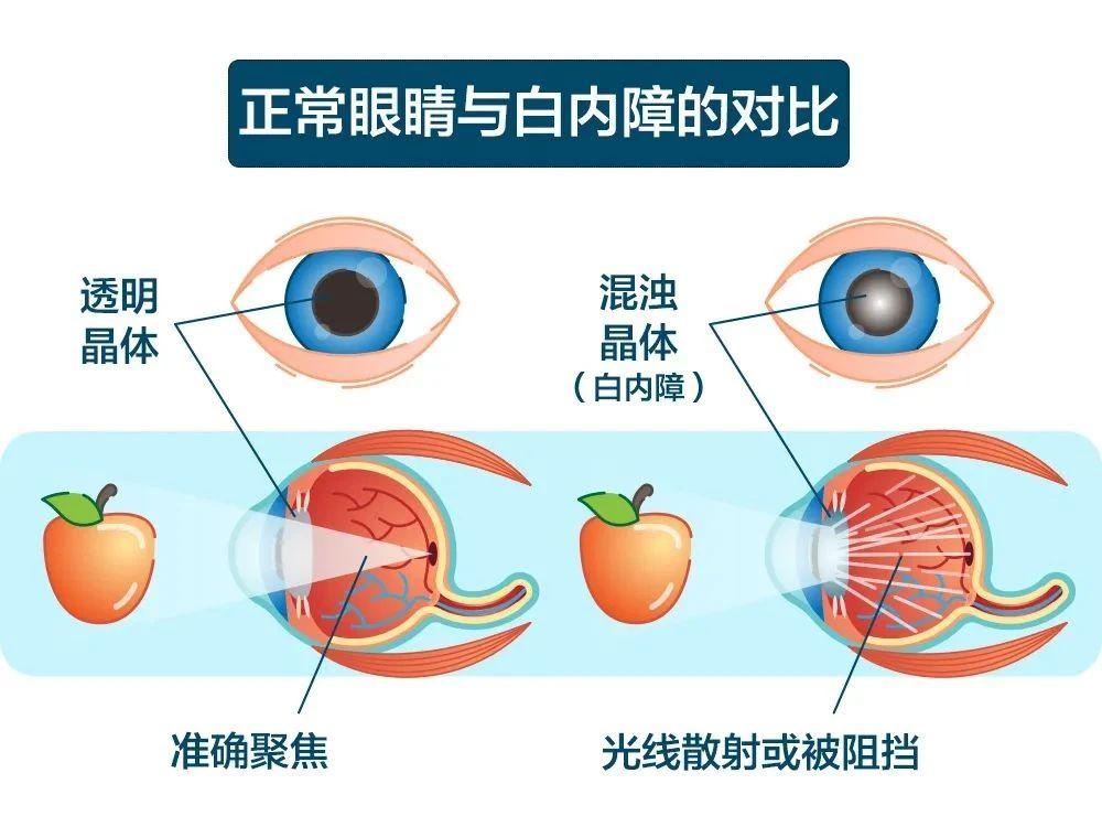 02 老年眼病二:白内障