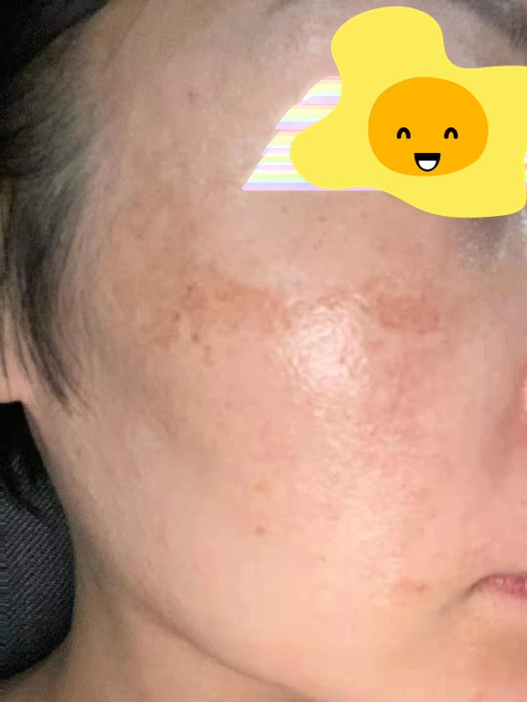 怀孕长的斑会自己消失吗