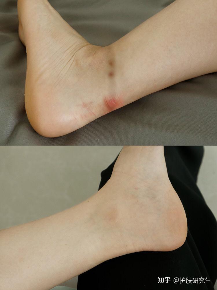 两个脚踝外侧很黑,硬币大小.不痛不痒,看起来很脏.有什么好方法去除?