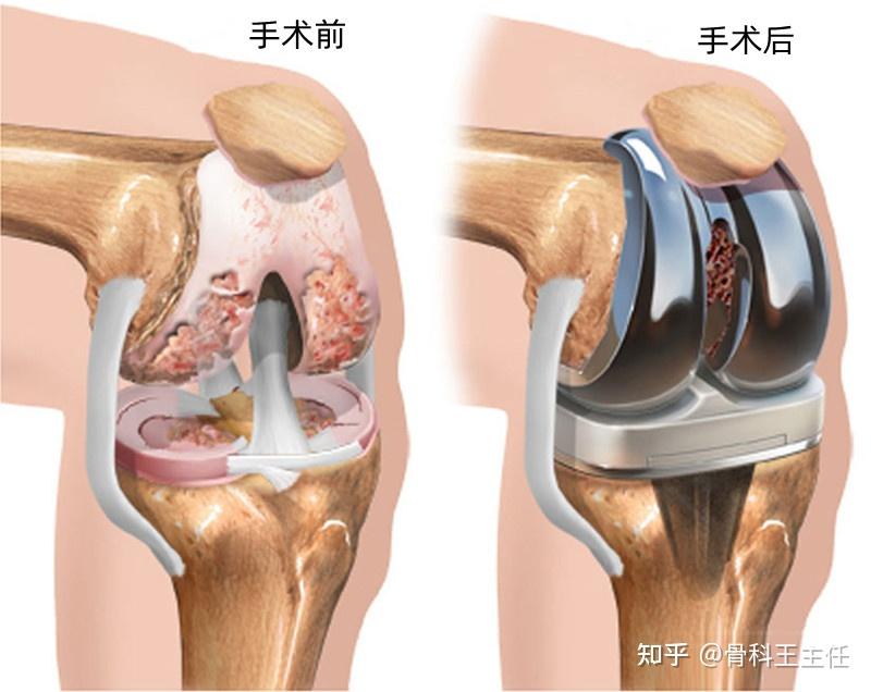 膝关节置换术是怎么做的?什么情况下需要换膝盖?