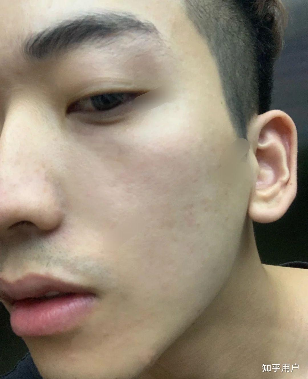 油性皮肤的男生怎样保养皮肤