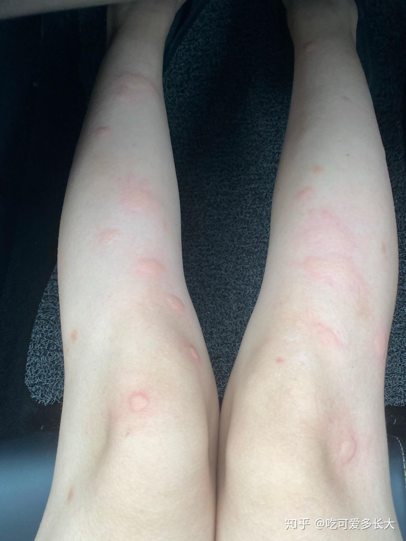 在南方,被毒蚊子咬是一种怎样的体验? - 知乎