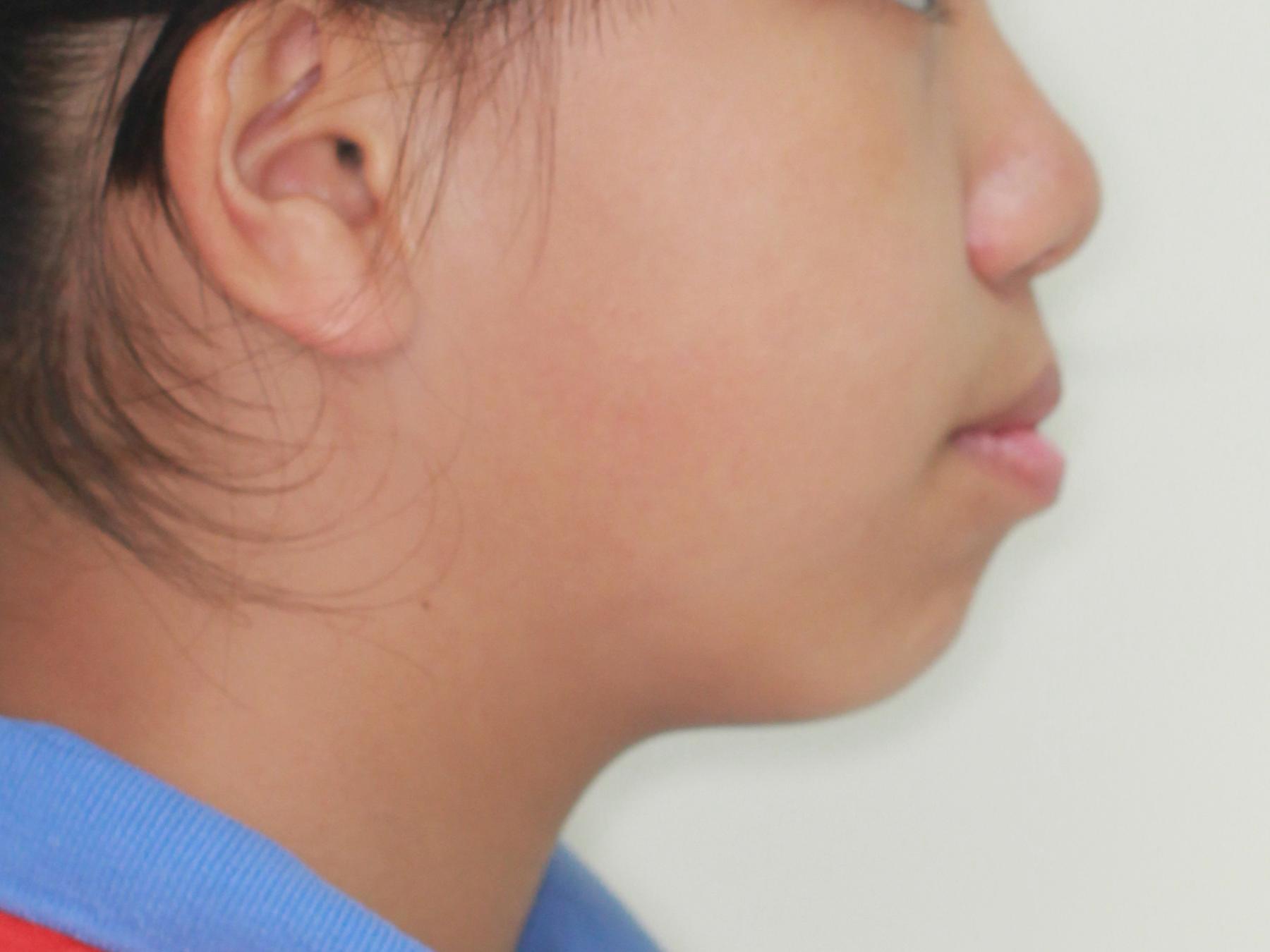 骨性上颌前突，下颌后缩-青少年矫正案例-曹海峰主治医师-爱问医生
