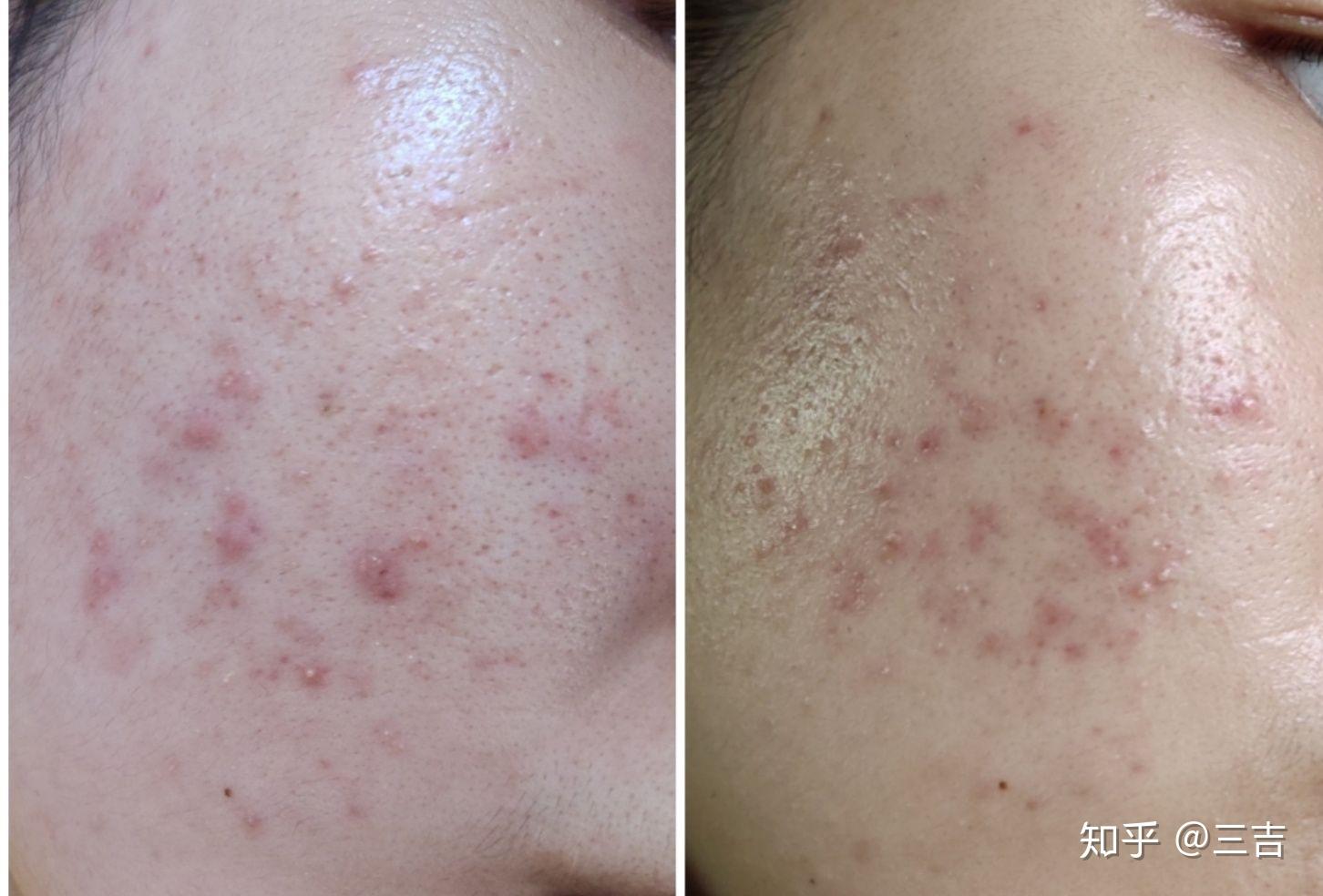 结束一个月的多西环素