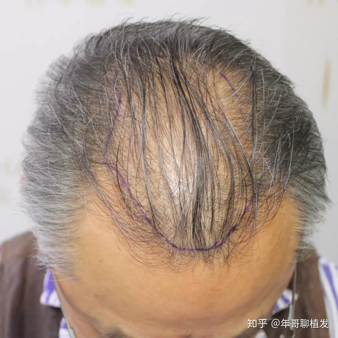 谁说66岁就不能植发老年人也有改变形象的权利