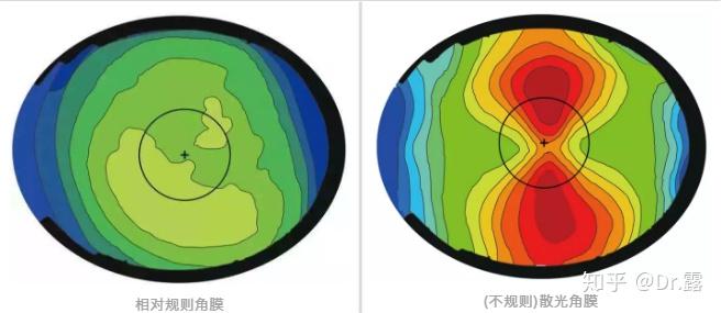 这也是验配角膜塑形镜过程中检查角膜地形图的原因之一