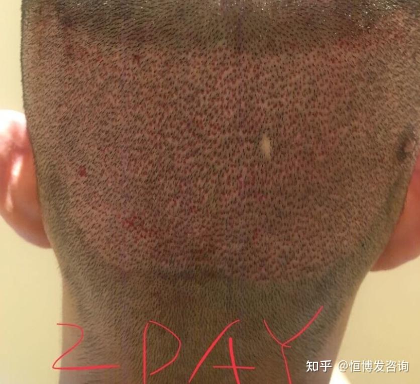 后脑勺(取发区)