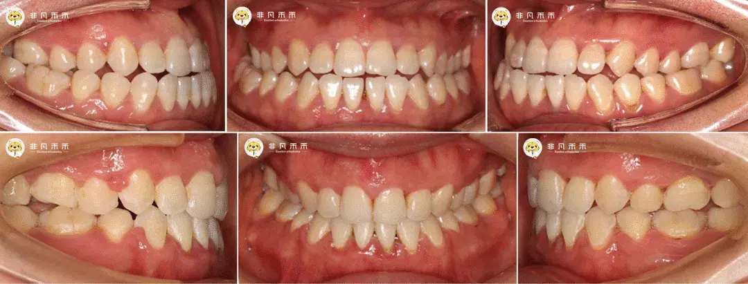 正畸病例嘴突地包天反病例1例