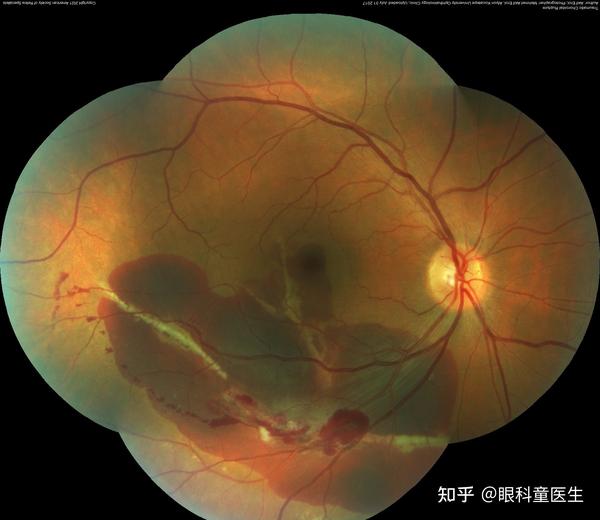 其他脉络膜病变——1、外伤性脉络膜破裂 - 知乎