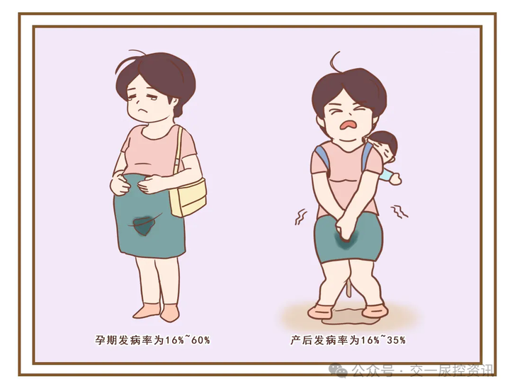 产后漏尿怎么办？如何治疗效果好？ - 知乎