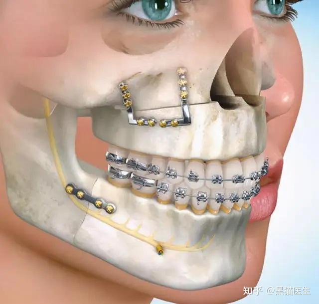 目前国内治疗下颌后缩的办法有哪些?