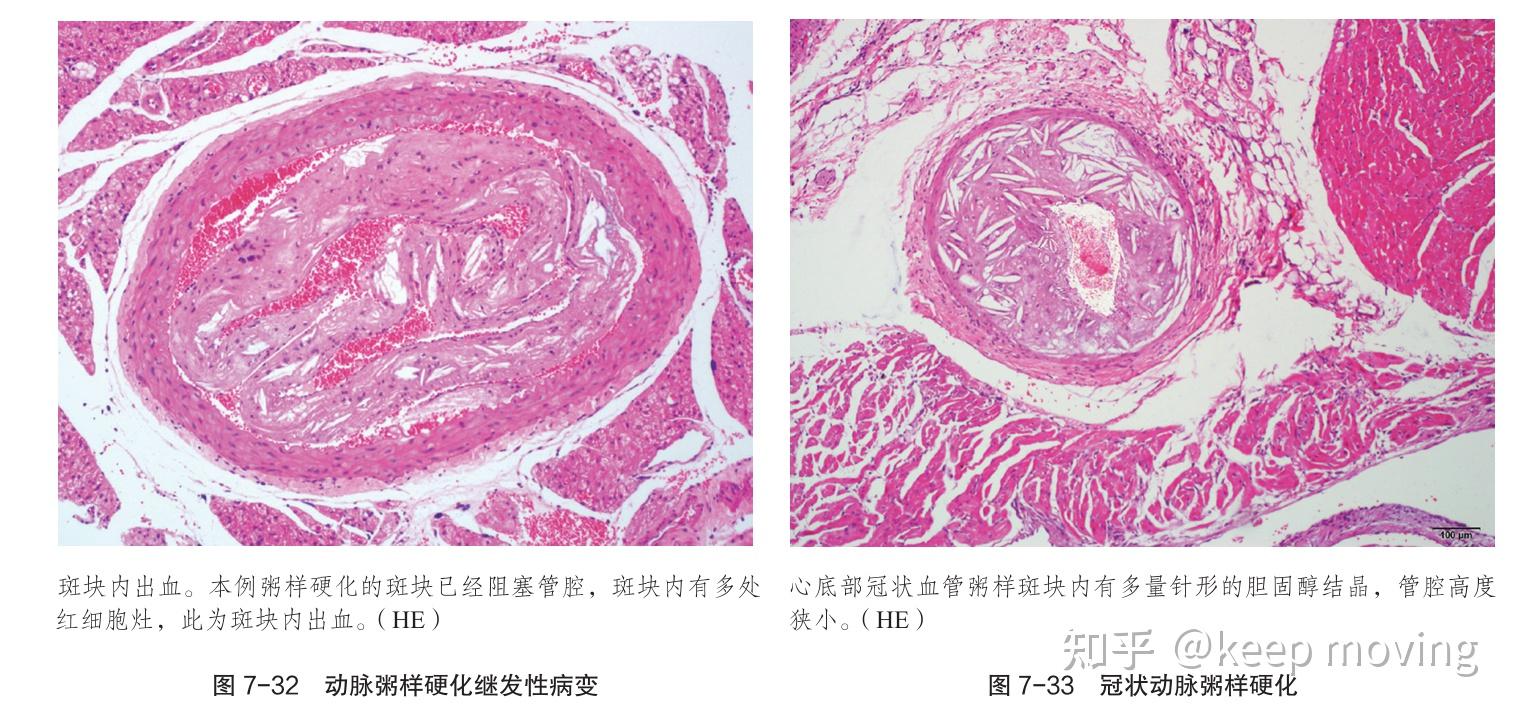 动脉粥样硬化病理变化及造模 - 知乎