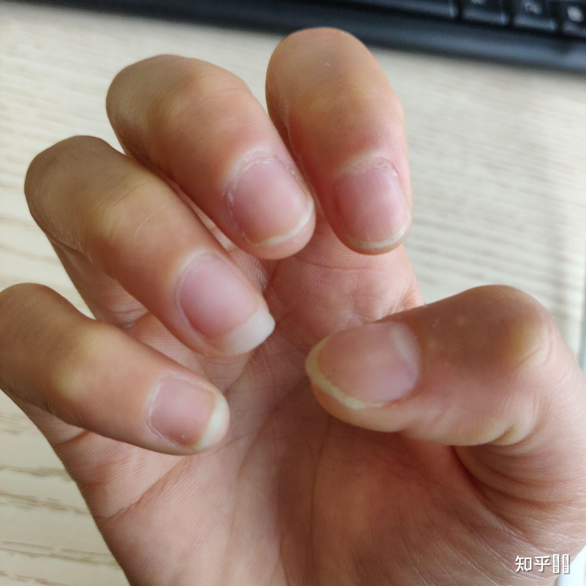 整块指甲抠得基本不剩了这样指甲能不能再长好呢