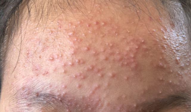 脸上都是小米粒疙瘩长了好多小白尖痘痘怎么回事内行人解读