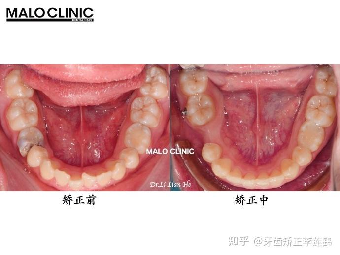 北京牙齒矯正丨深覆合深覆蓋有什麼危害