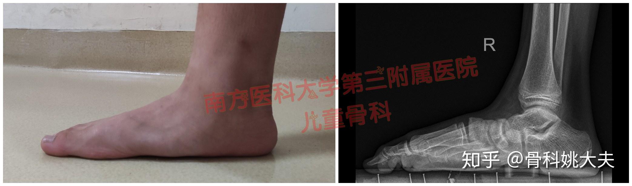 扁平足(平足症)