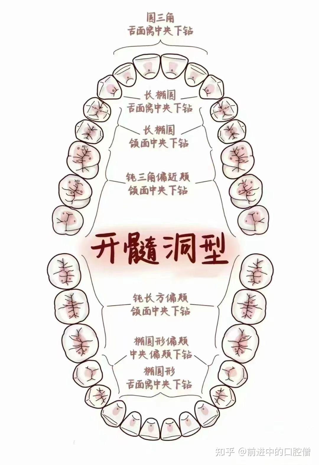 牙齿根管治疗分解图图片